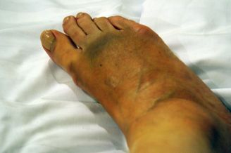 Bruised foot Bruised foot